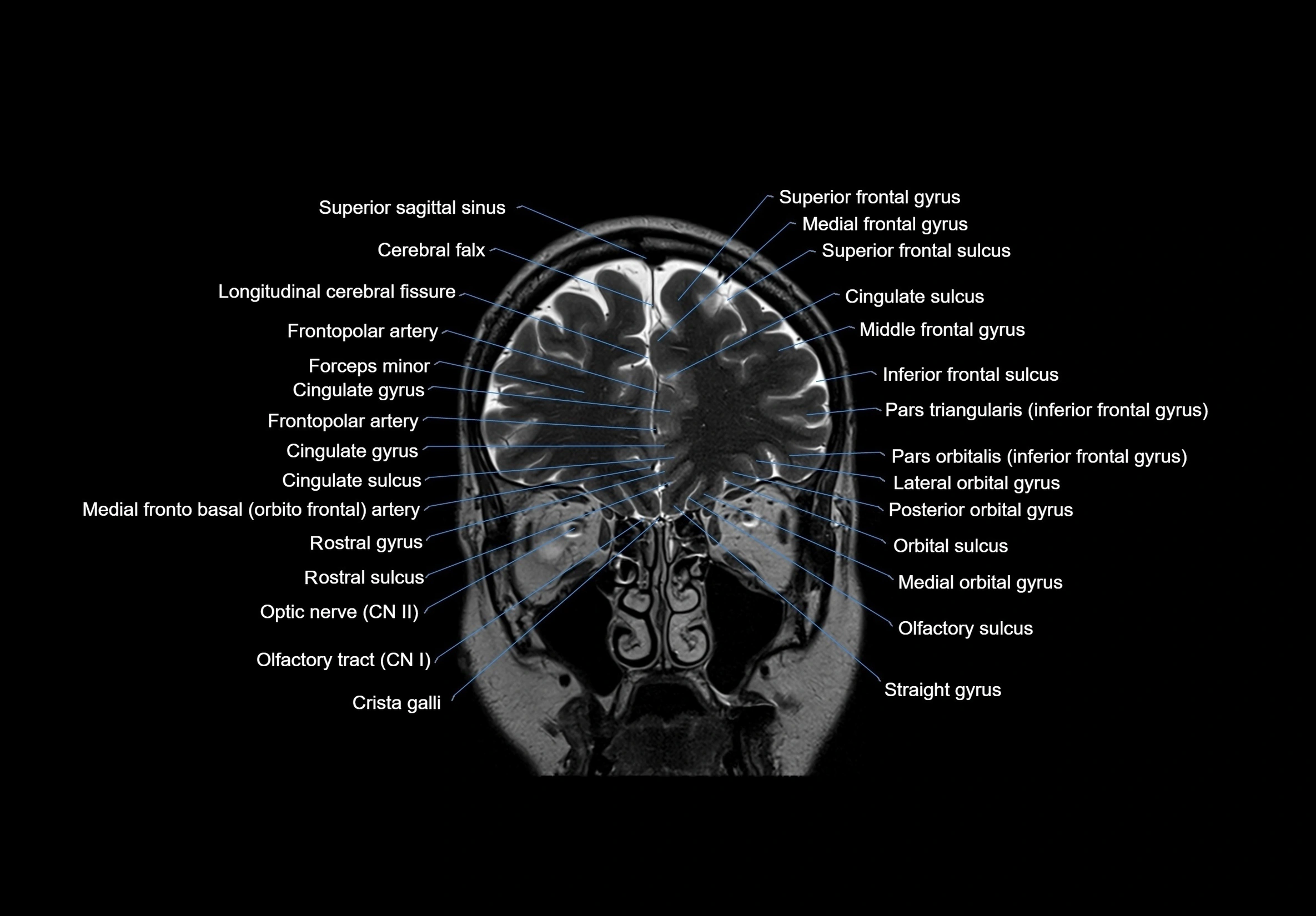 MRI Brain coronal cross sectional labelled anatomy 3T image  -img-00001-00017.webp